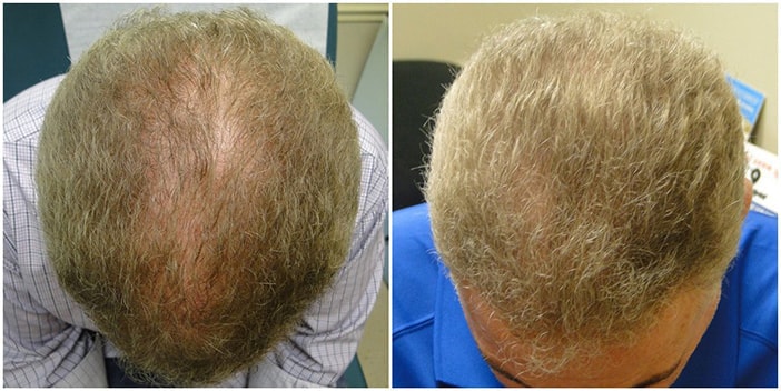 Before Image 1, Restylane Plano