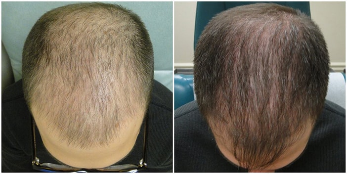 Before Image 2, Restylane Plano