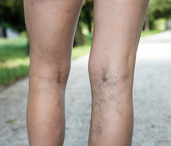 Dr. Selkin Bryan at Dermatology Center explains whether laser therapy right for you.
