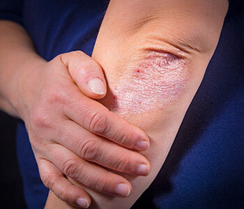 Dr. Selkin Bryan at Dermatology Center explains how psoriasis is treated.