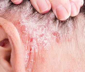 Using NB UVB Therapy for psoriasis in McKinney, Texas