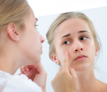 woman have acne on her face, treatment for acne from Dr. Bryan Selkin