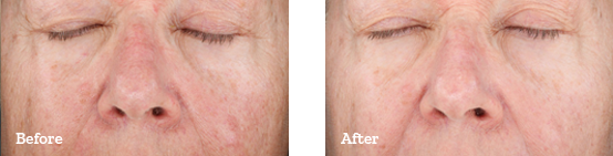 Chemical Peels Before After 01