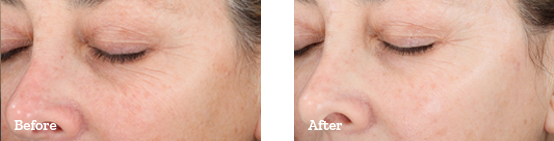 Chemical Peels Before After 02