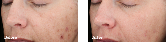 Chemical Peels Before After 03