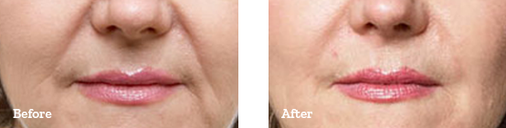 Juvederm Before After image 02
