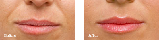 Juvederm Before After image 03