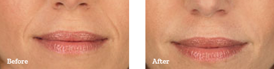 Juvederm Before After image 05