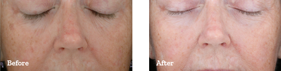 Photodynamic Therapy Before After image 01