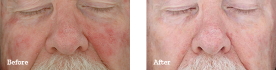 Photodynamic Therapy Before After image 02