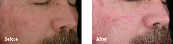 Photodynamic Therapy Before After image 03