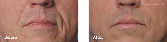 Restylane Before After image 01
