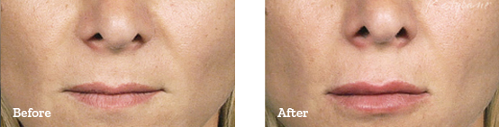 Restylane Before After 10