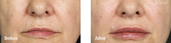 Restylane Before After image 11