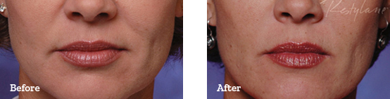 Restylane Before After image 02