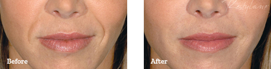 Restylane Before After image 03
