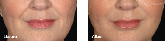Restylane Before After image 05