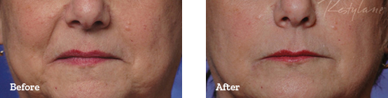 Restylane Before After image 06