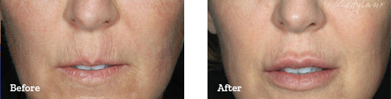 Restylane Before After image 07