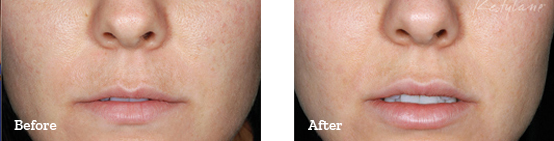 Restylane Before After image 08