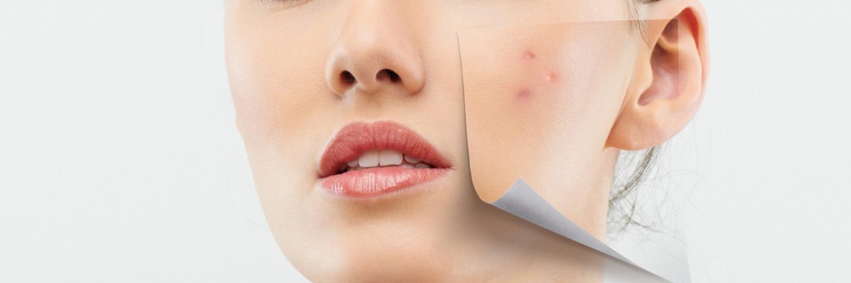 Flower Mound area patients ask, what causes acne?