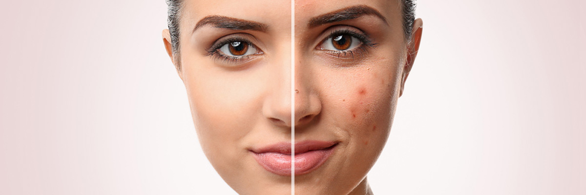 Woman face before and after acne treatment procedure