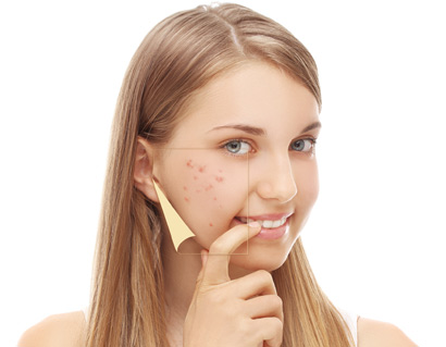 Girl with acne in her cheek