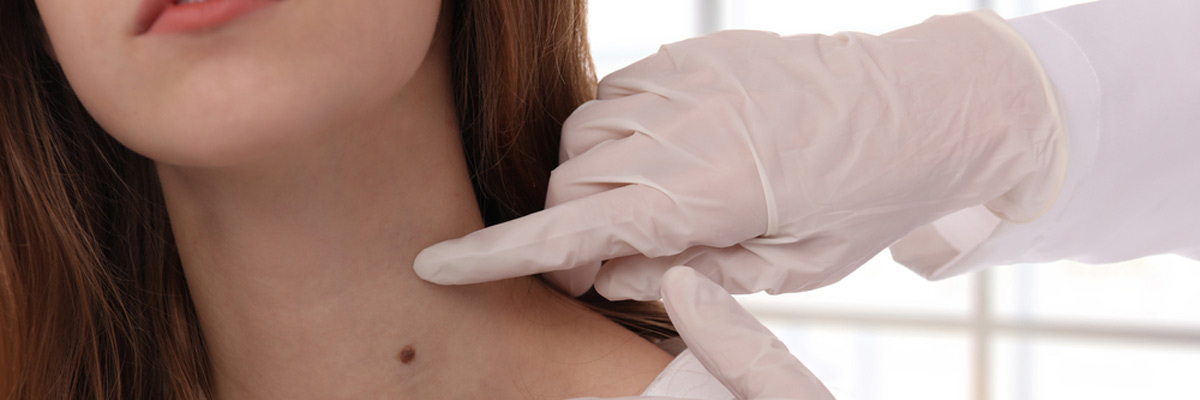 Doctor dermatologist examines birthmark of patient