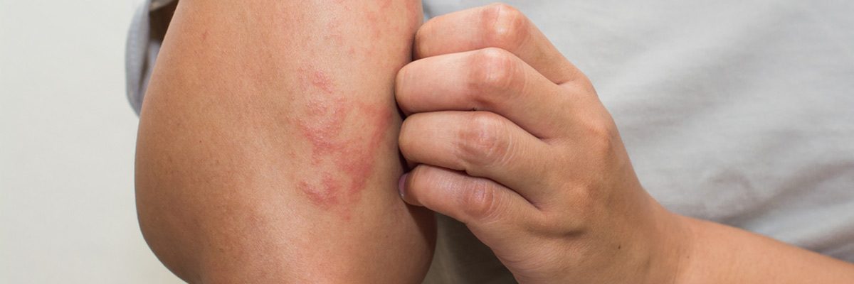 McKinney area dermatologist discusses the possible causes of eczema
