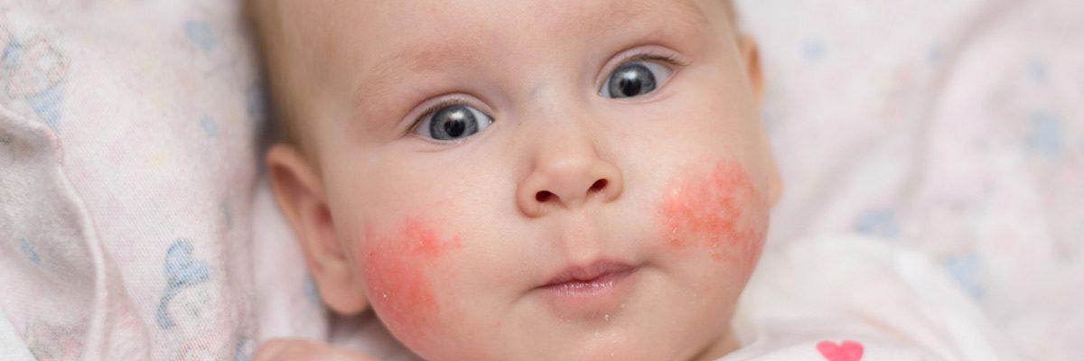 Plano parents inquire about eczema care for Children