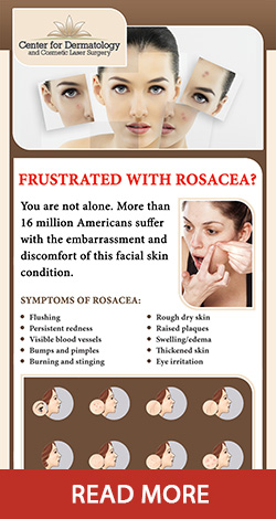 Rosacea Plano - Rosacea InfoGraphic