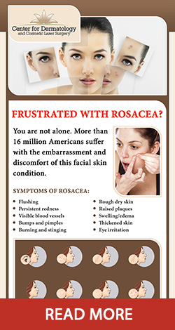 Rosacea Plano - Rosacea InfoGraphic Rosacea Plano - Rosacea InfoGraphic