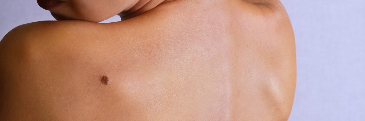 Flower Mound, Texas area dermatologist describes melanoma skin cancer
