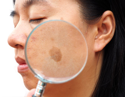 melasma doctors near me