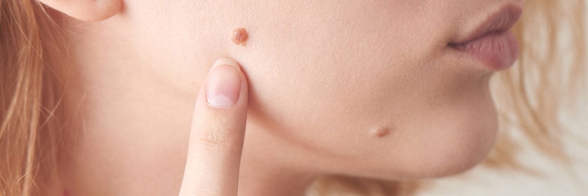 Patients in the McKinney area ask how to spot a cancerous mole
