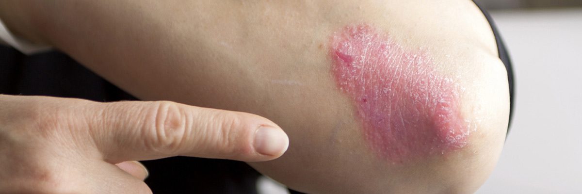 The basics of psoriasis treatment from a Flower Mound dermatologist