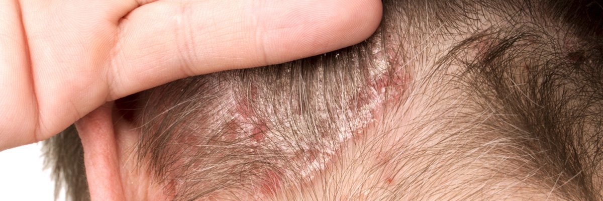 Assessing Types of Psoriasis Conditions Responsible for Discomfort