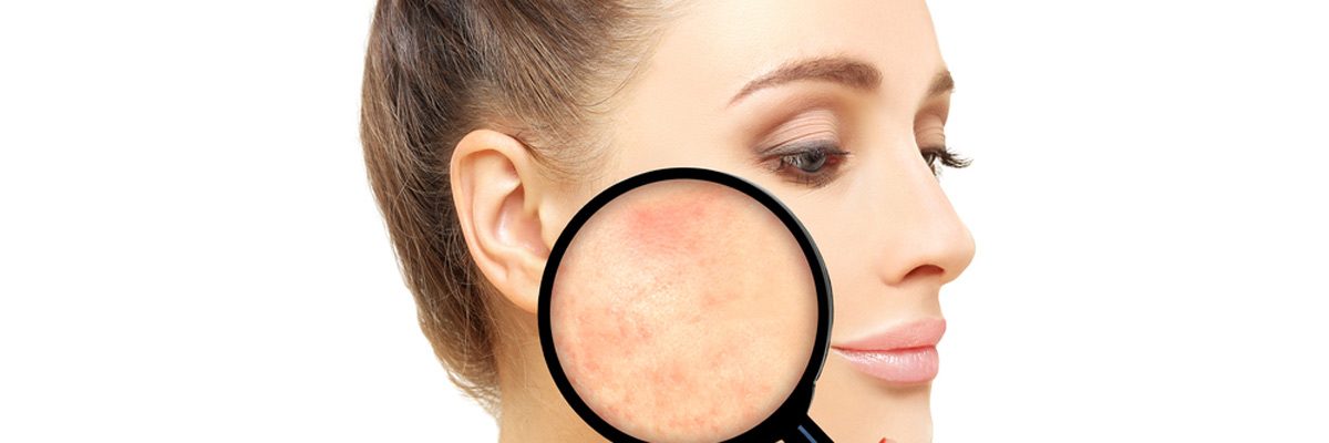 Treatment For Rosacea Is A Phone Call Away With Center for Dermatology
