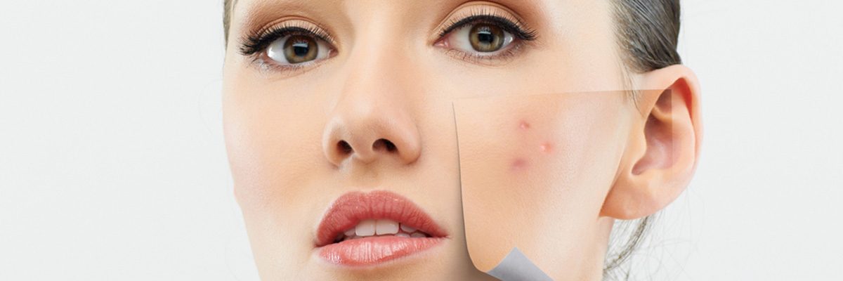 Our Dermatologist Describes Options Available for Treatment of Rosacea
