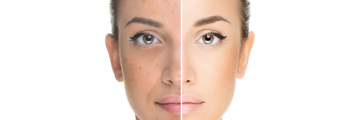 Plano doctor explains that rosacea can be mistaken for acne