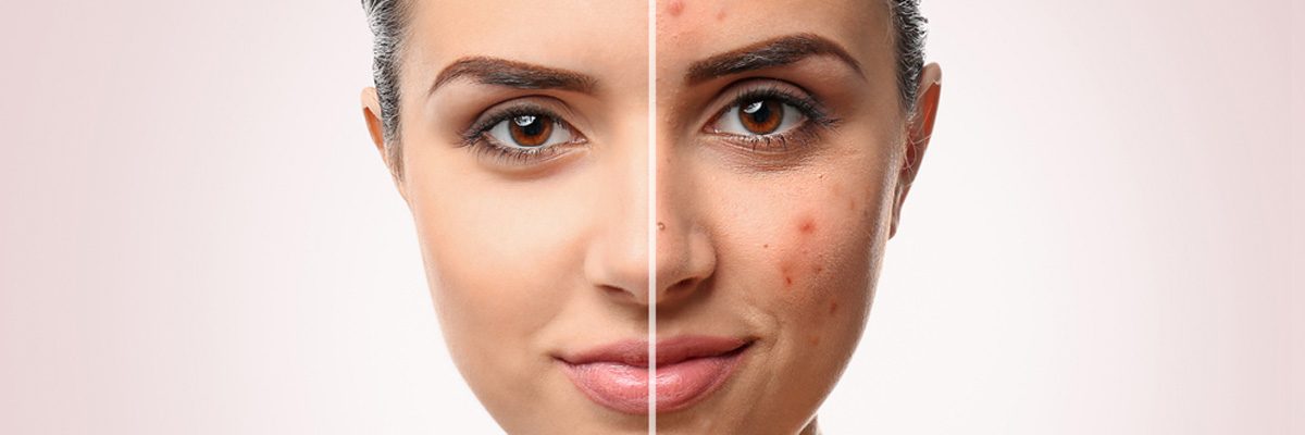 Various Treatment Options Including Light Therapy For Acne