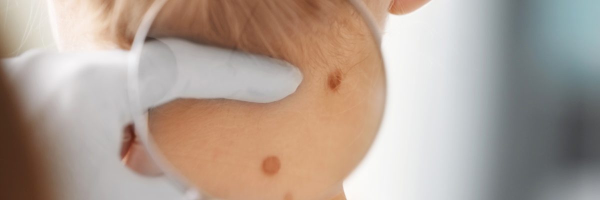 Plano dermatologist describes the different types of birthmarks
