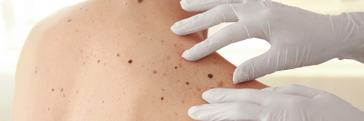 What are the stages of melanoma for Plano area residents?