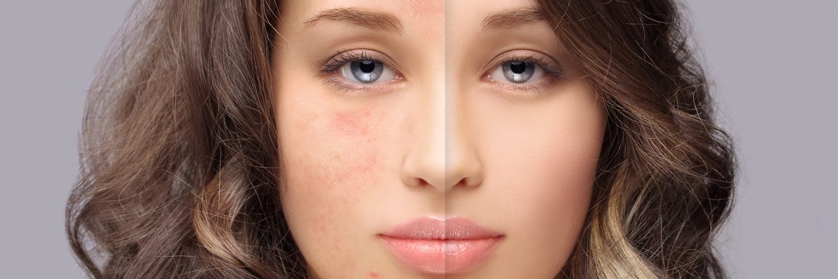 Plano, TX area patients ask, “What is rosacea and what causes it?”