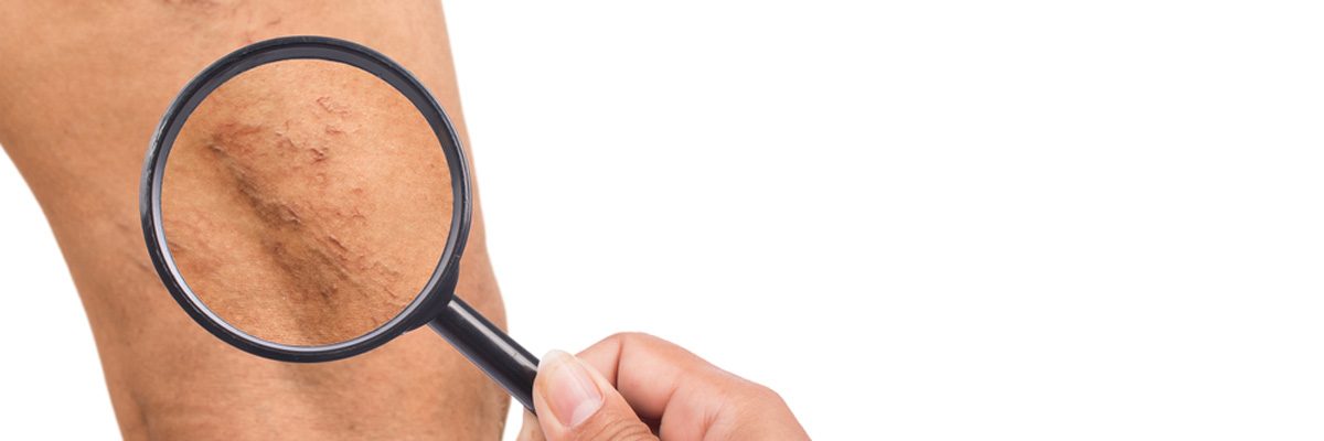 Health Risks Associated With Varicose Veins